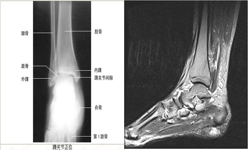 踝关节扭伤后为什么"经久不愈"?