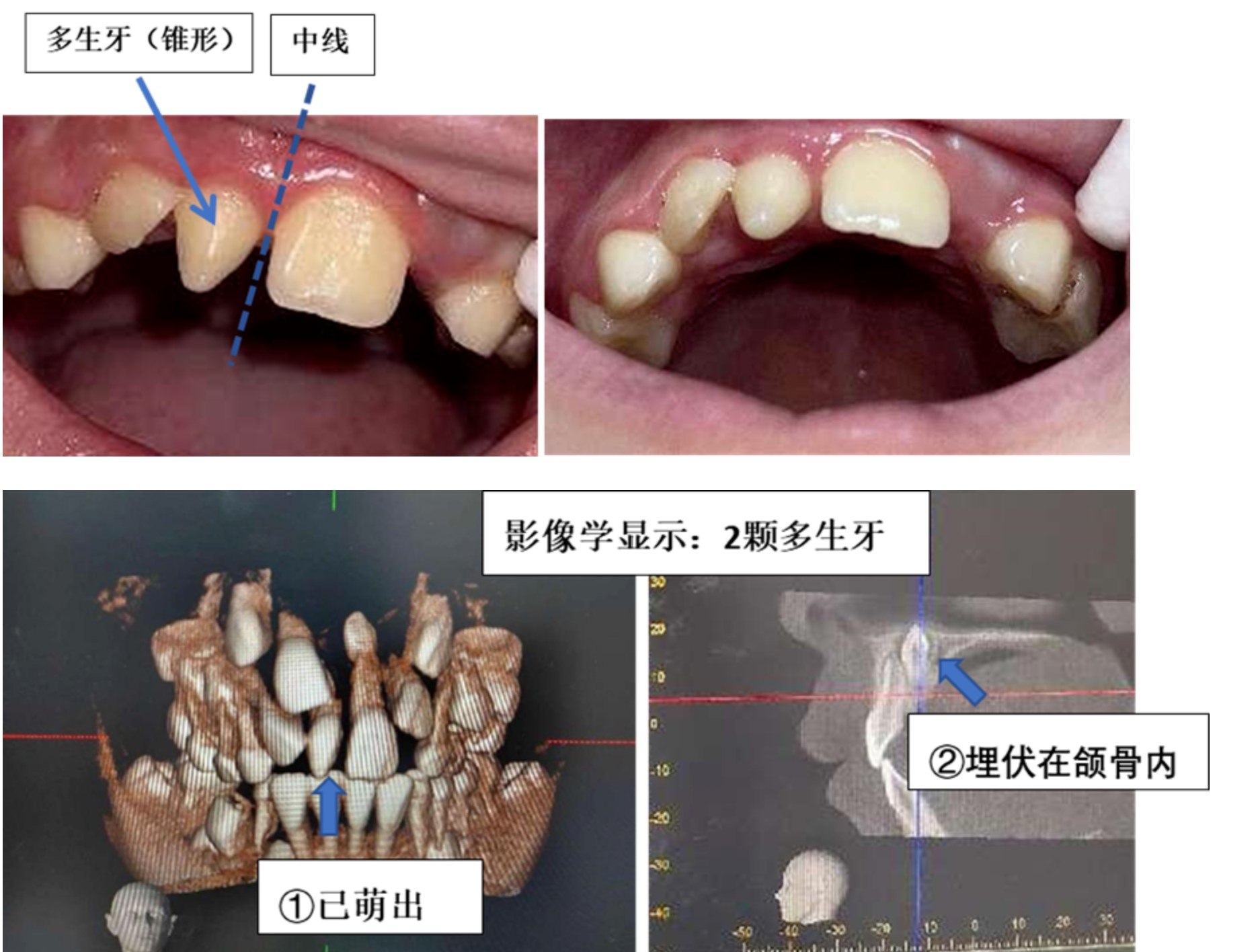 十岁孩子矫牙记（上门牙倒置） - 知乎